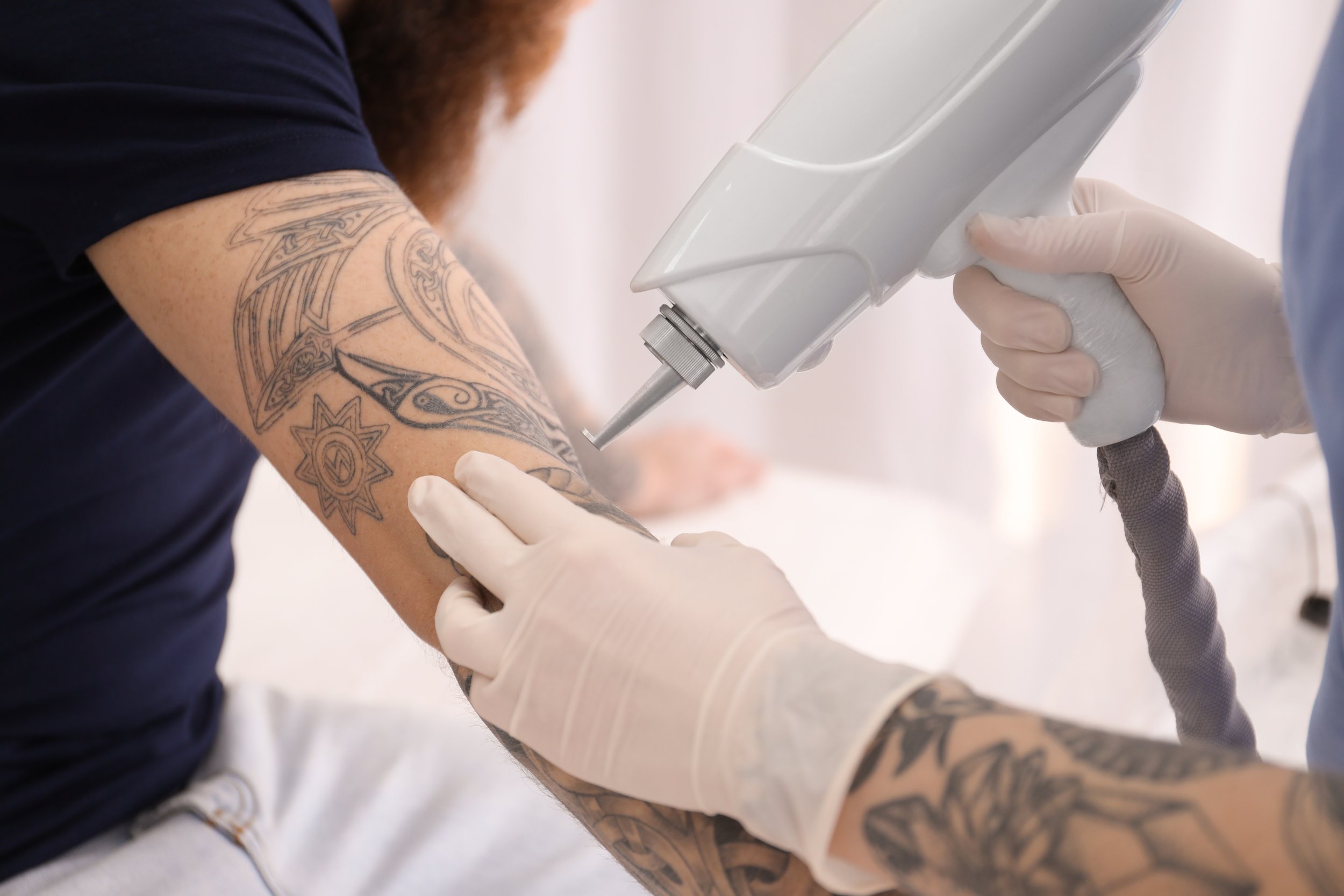 Laser Tattoo Removal Training  YouTube