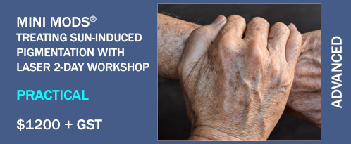 GAIN Laser for Pigmentation Treatments