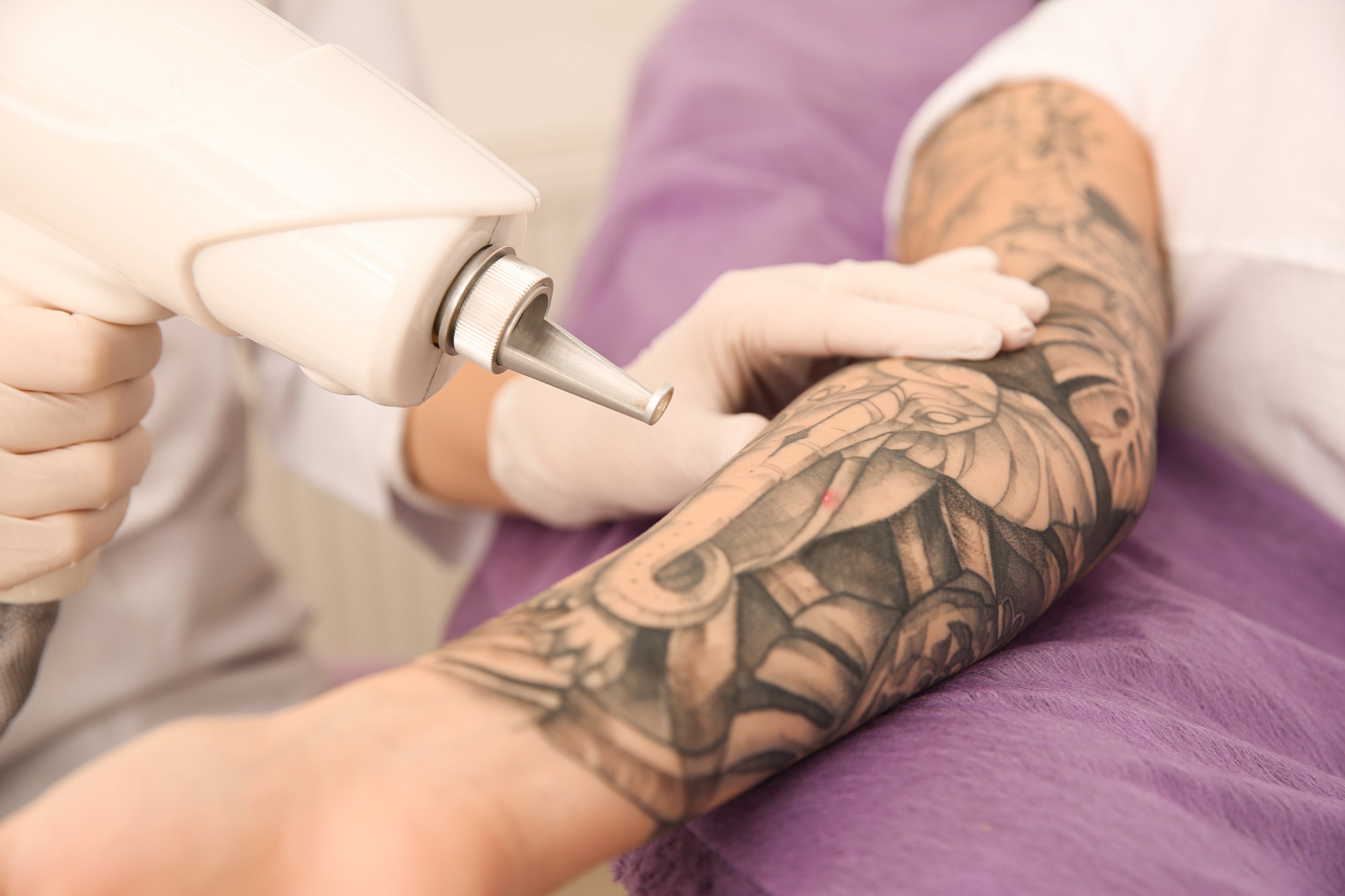 Mobile Tattoo Removal anywhere in Christchurch – Asylum Laser Tattoo Removal