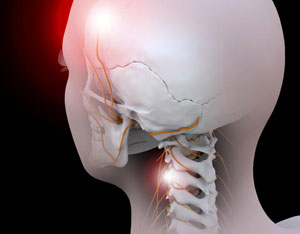 Cervicogenic+headache.jpg
