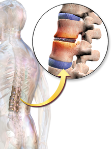 backpain-disc djd.png
