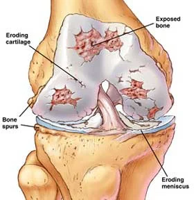 joint-pain1.jpg