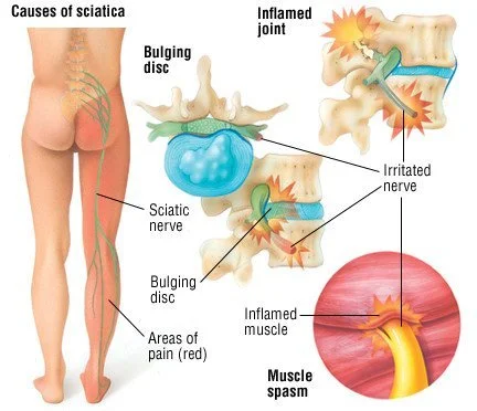 How can Chiropractic help Sciatica?