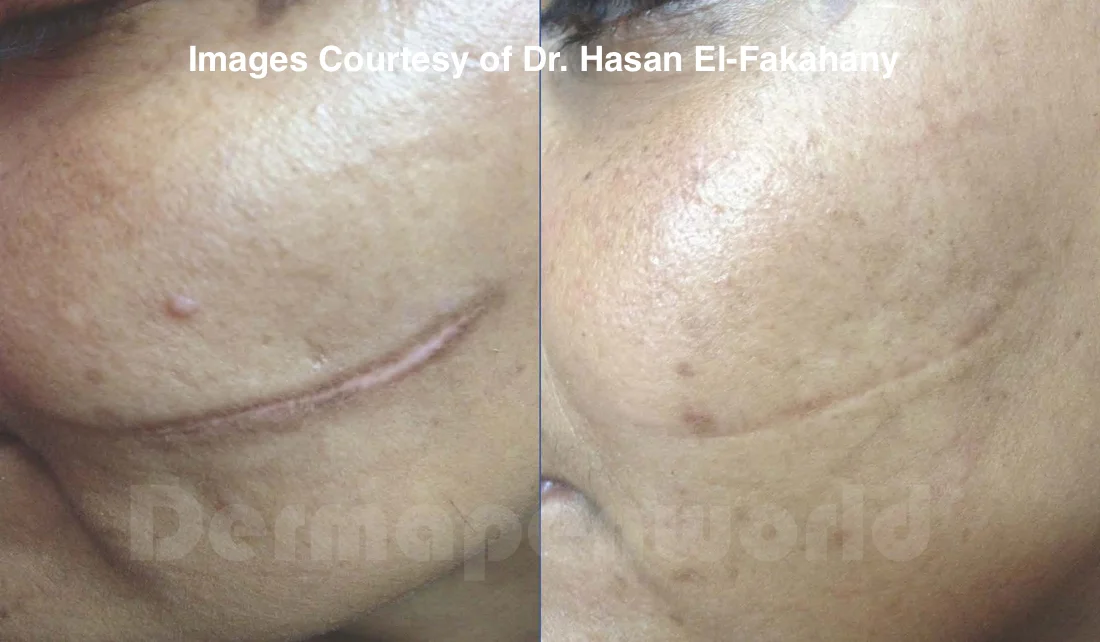 Dermapen Skin Needling Natashas Skin Spa