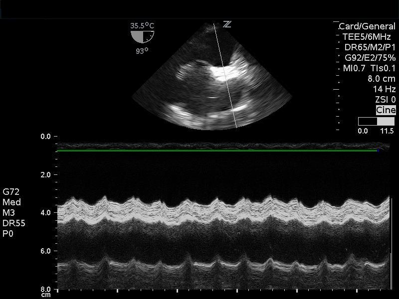image 6. m-mode through svc in bicaval view