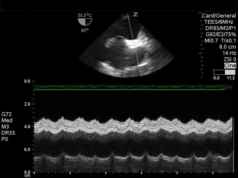 The right tool for the right patient: Resuscitative TEE in the diagnosis of massive PE in the ED
