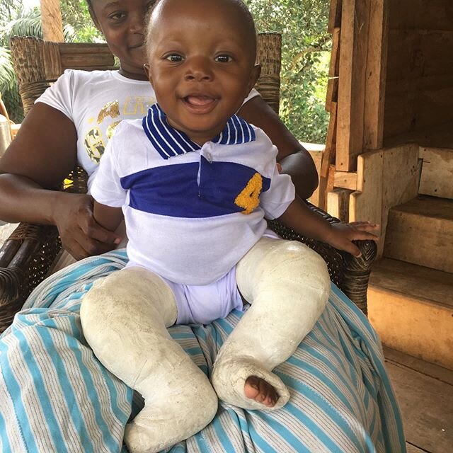 Graham wants to walk like his twin, but he was born with club feet.  This is his journey: 1) Graham in caste two months after surgery. 2) Graham standing with his twin.  3) Graham showing off his shoes with one of the best smiles in the world.