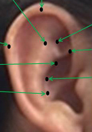 Auricular-acupuncture-points-chosen-for-treatment.png