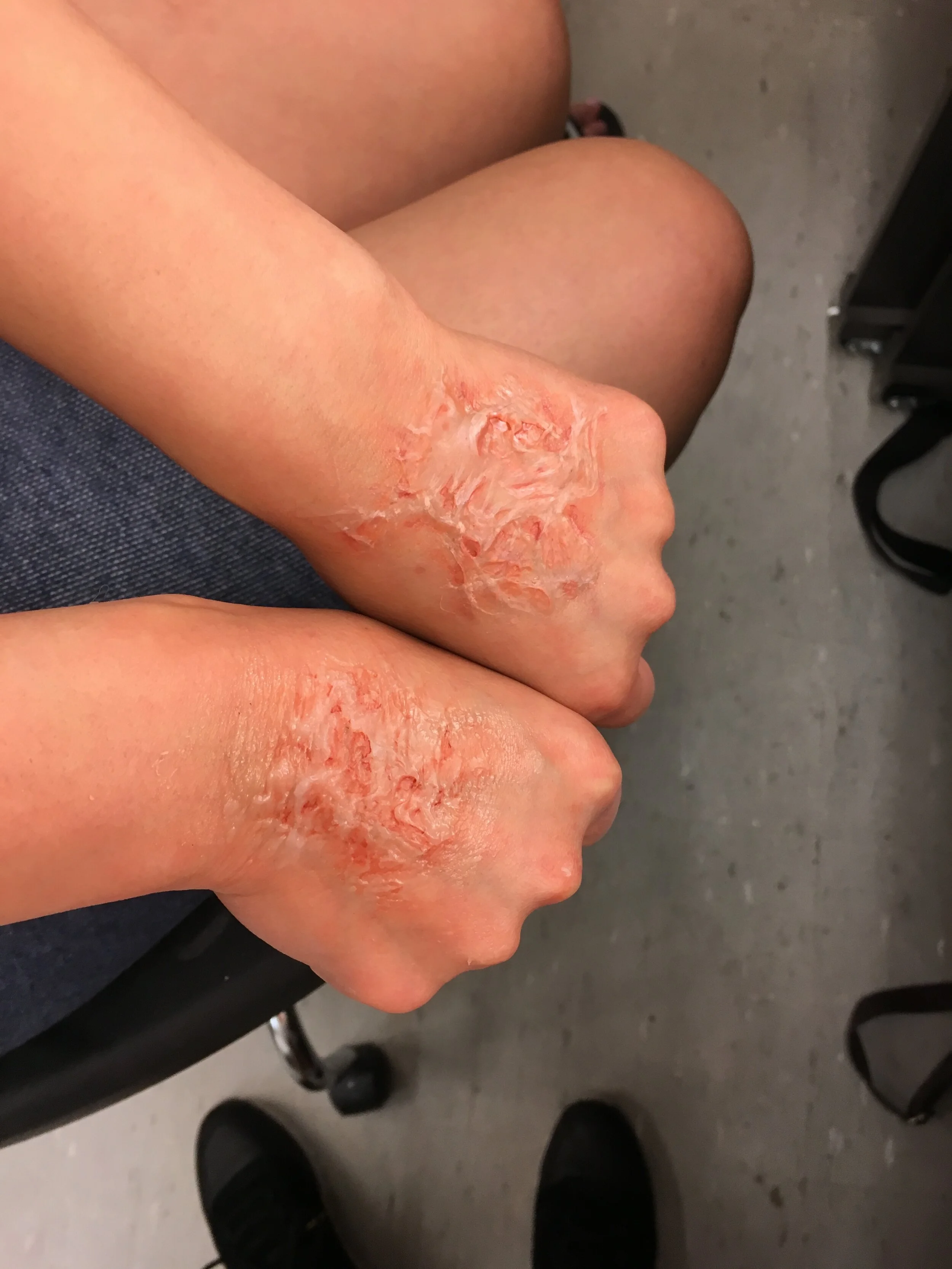 Out-of-kit Burn