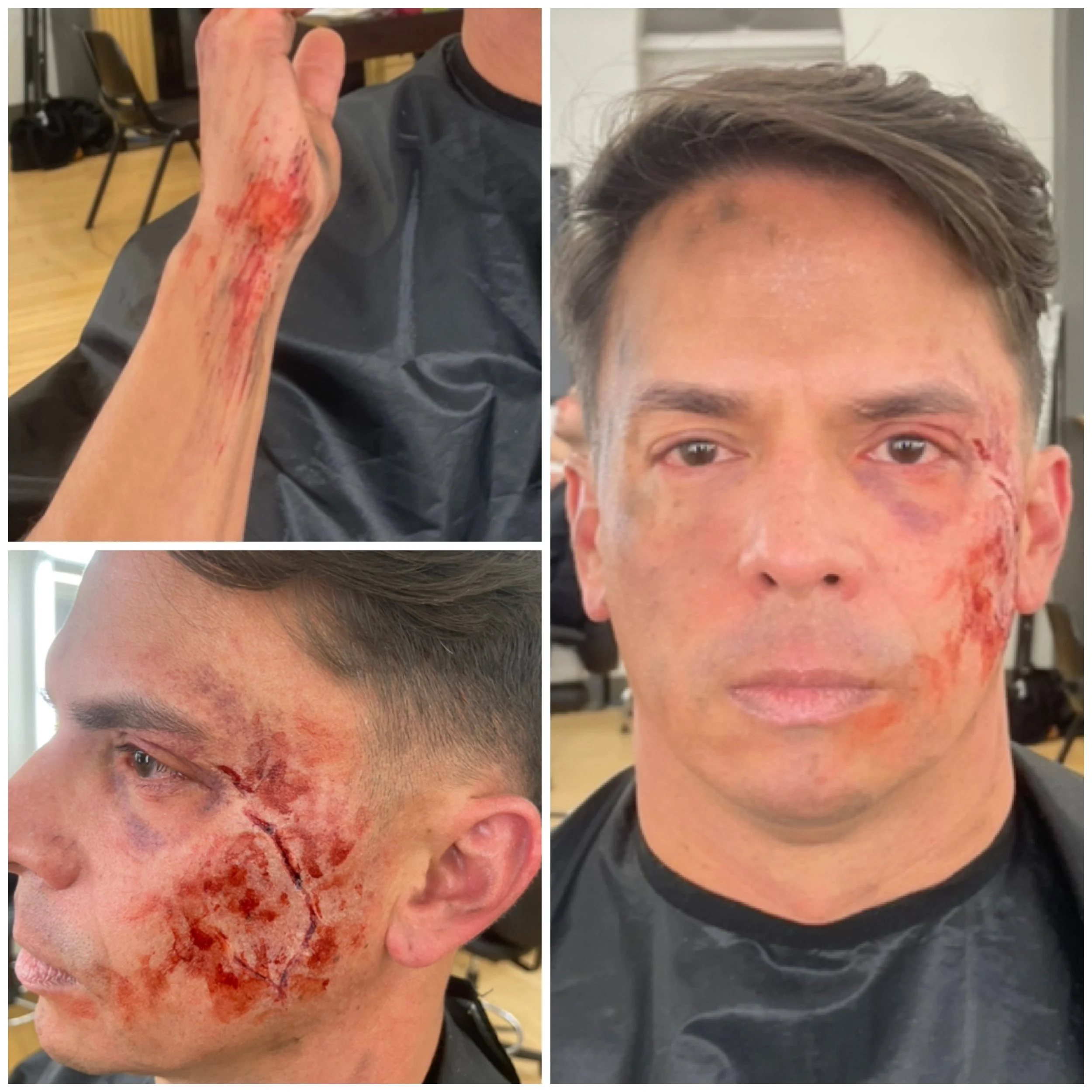 Character Breakdown - Explosion & Exposure Victim (out-of-kit)