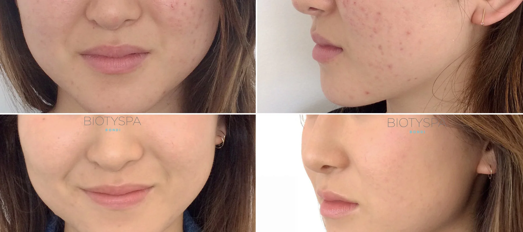 03-facial_peel-before_after.jpg