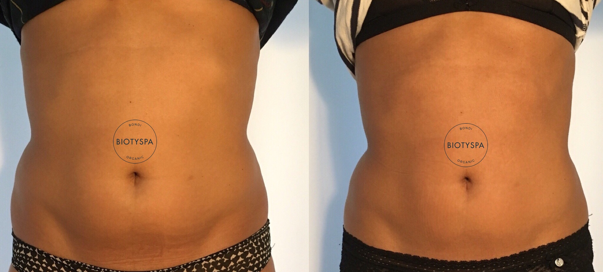 slimming-treatment-biotyspa-activeslim.jpg