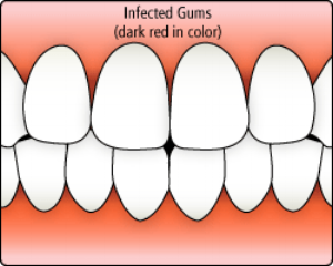 Gingivitis.gif