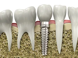 Implant.jpg