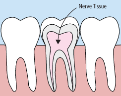 Root-Canals.gif