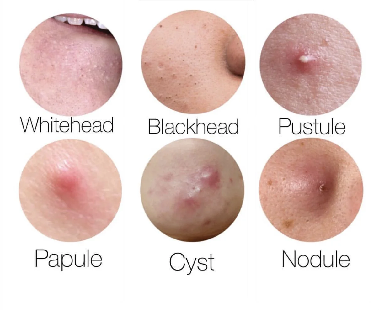 What Type of Acne Do You Have?