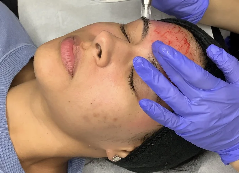 Microneedling, Benefits and FAQs Answered