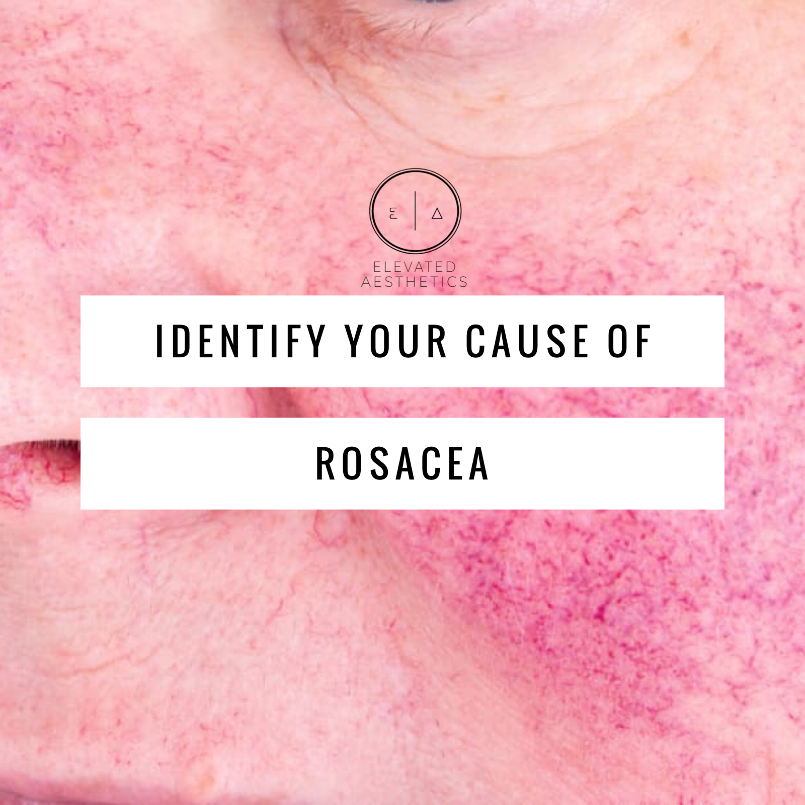 Idenity Your Cause of Rosacea