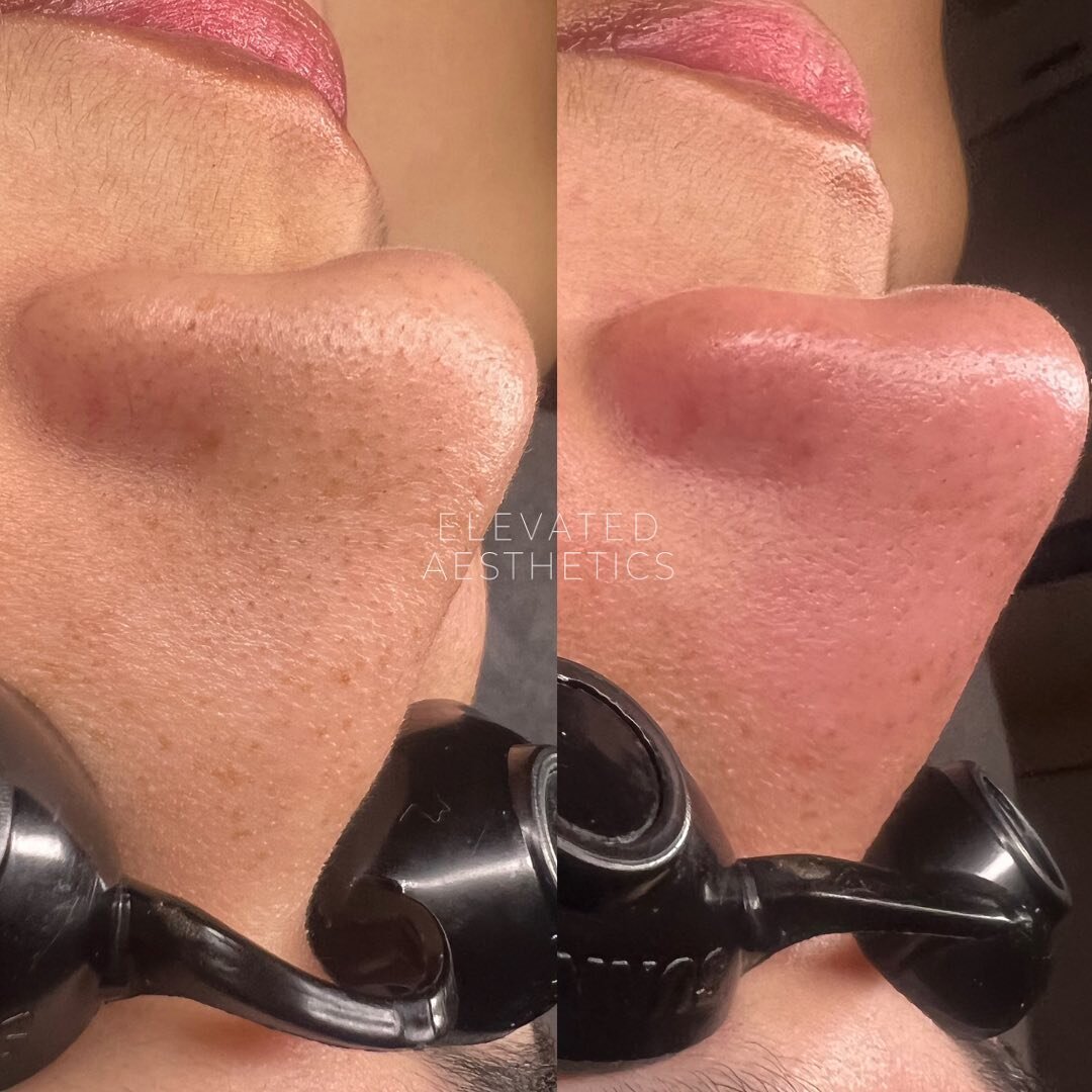 An immediate before and after of nose extractions, what a difference!

Blackheads are normal and will always reappear in areas of the skin where pores are enlarged and there&rsquo;s more oil flow. 

We recommend facials every 4-6 weeks to refine the 