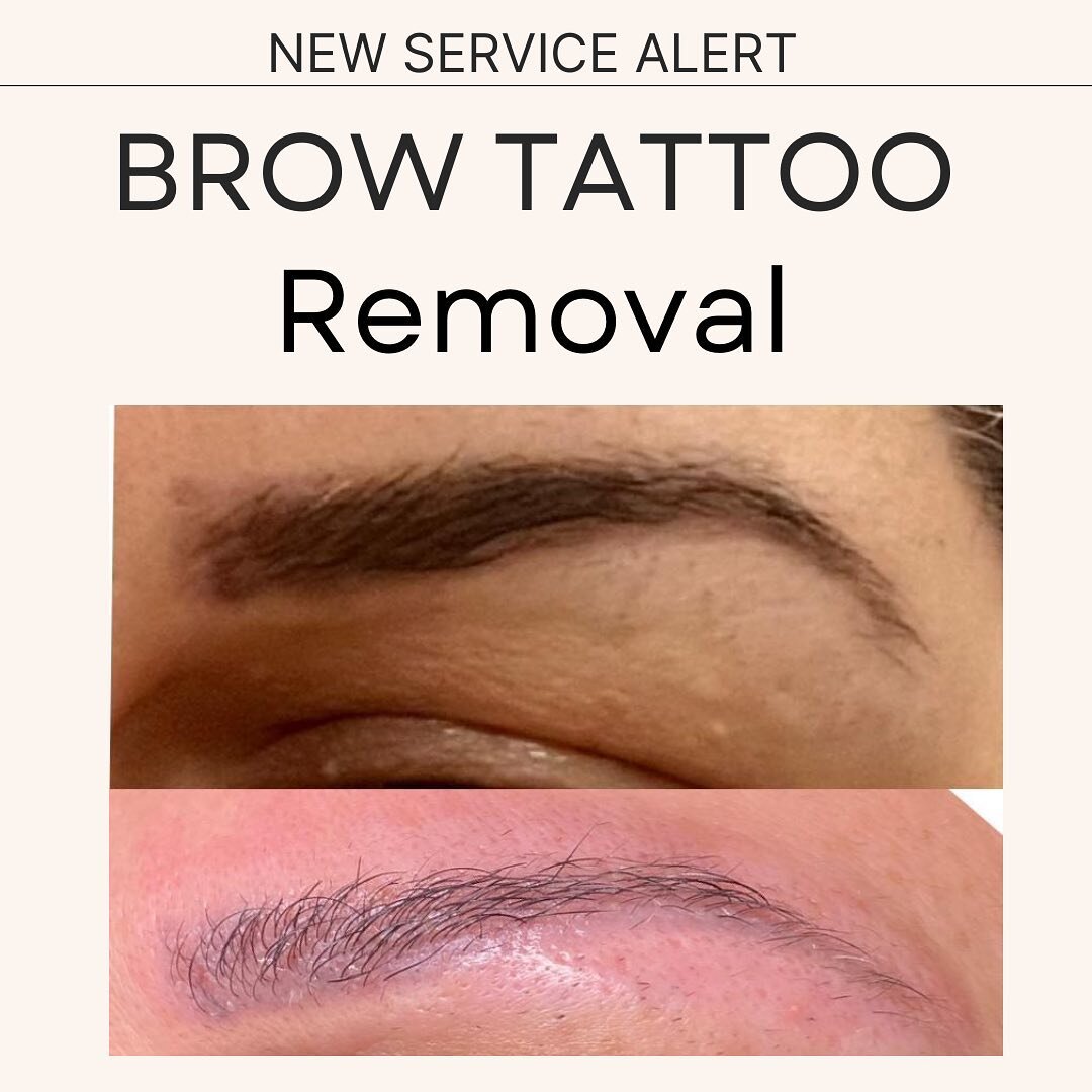 Whether you want to remove previously microbladed brows or brows that have changed colors over the years this service is designed for you.

Using a glycolic acid solution we draw out old pigment from your brows creating a lighter shade gradually. 

#