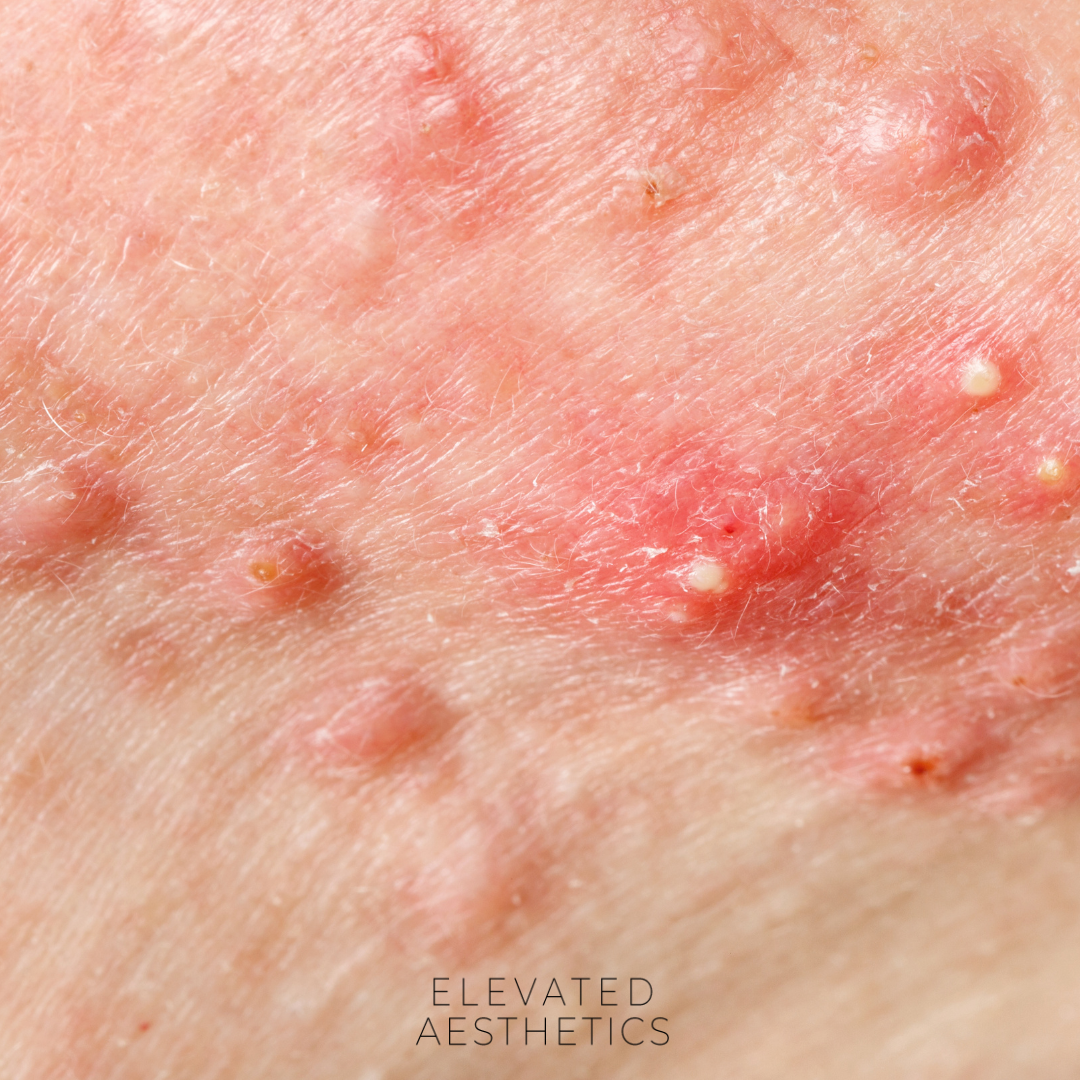 June is Acne Awareness Month: Here's a Glimpse of My Journey 