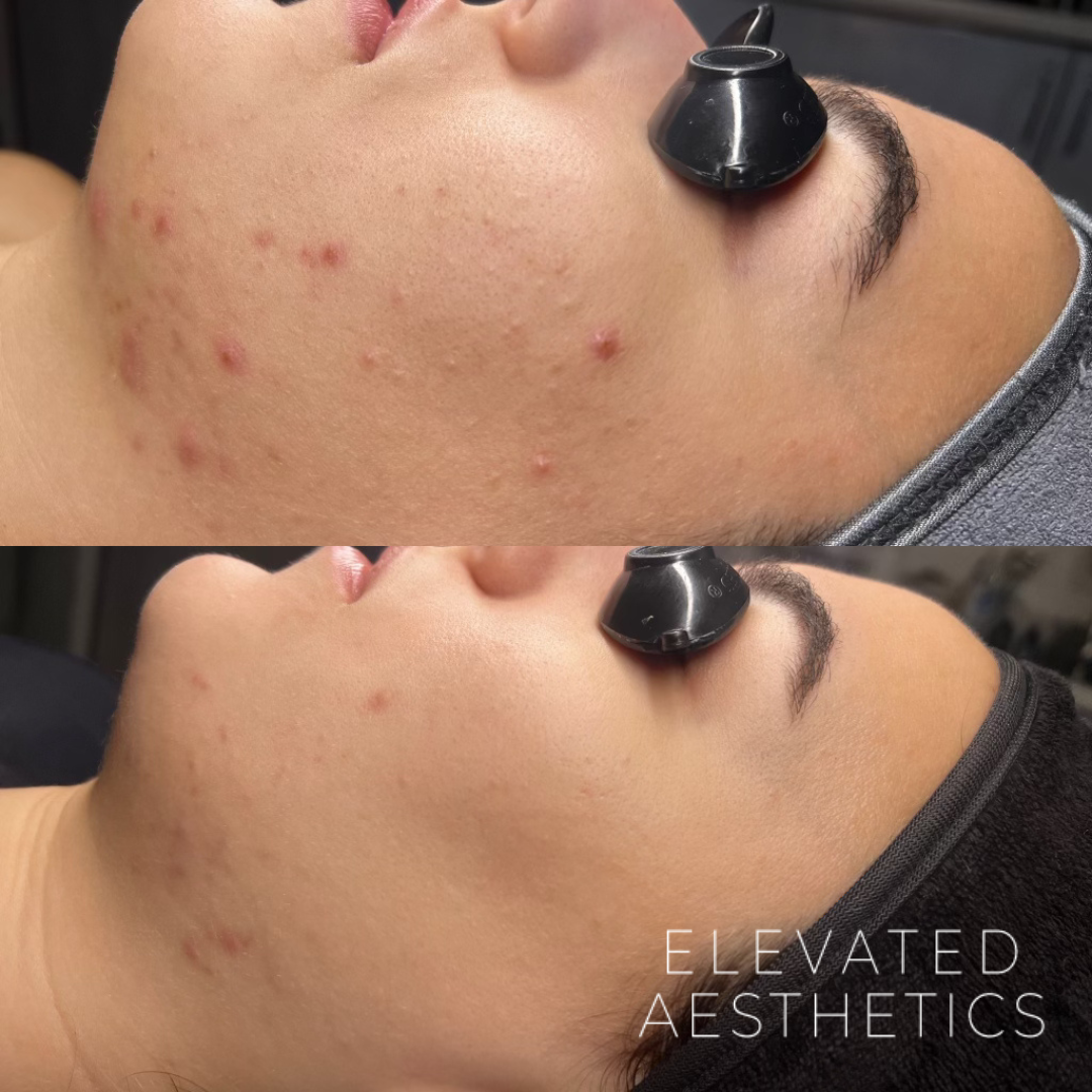 Why Acne Bootcamp Takes Your Skin to the Next Level