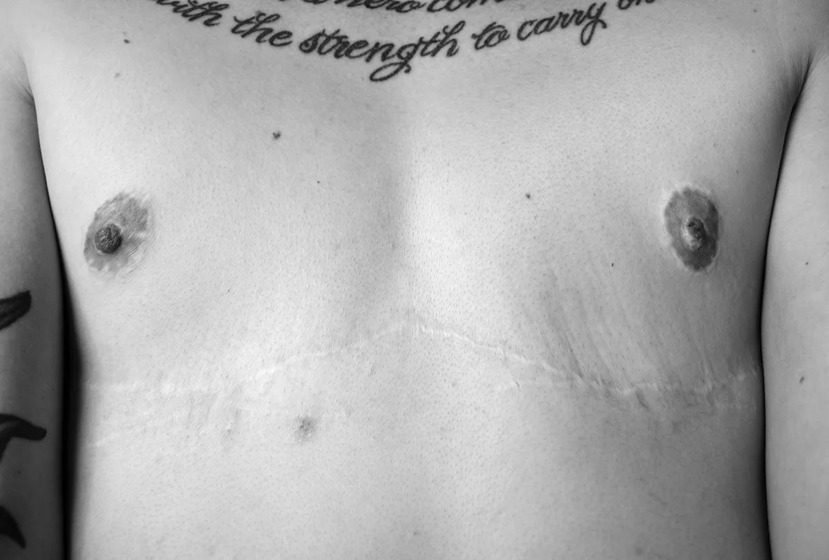 10_Healed_Chest_Two_Years_Post_Op_.jpg