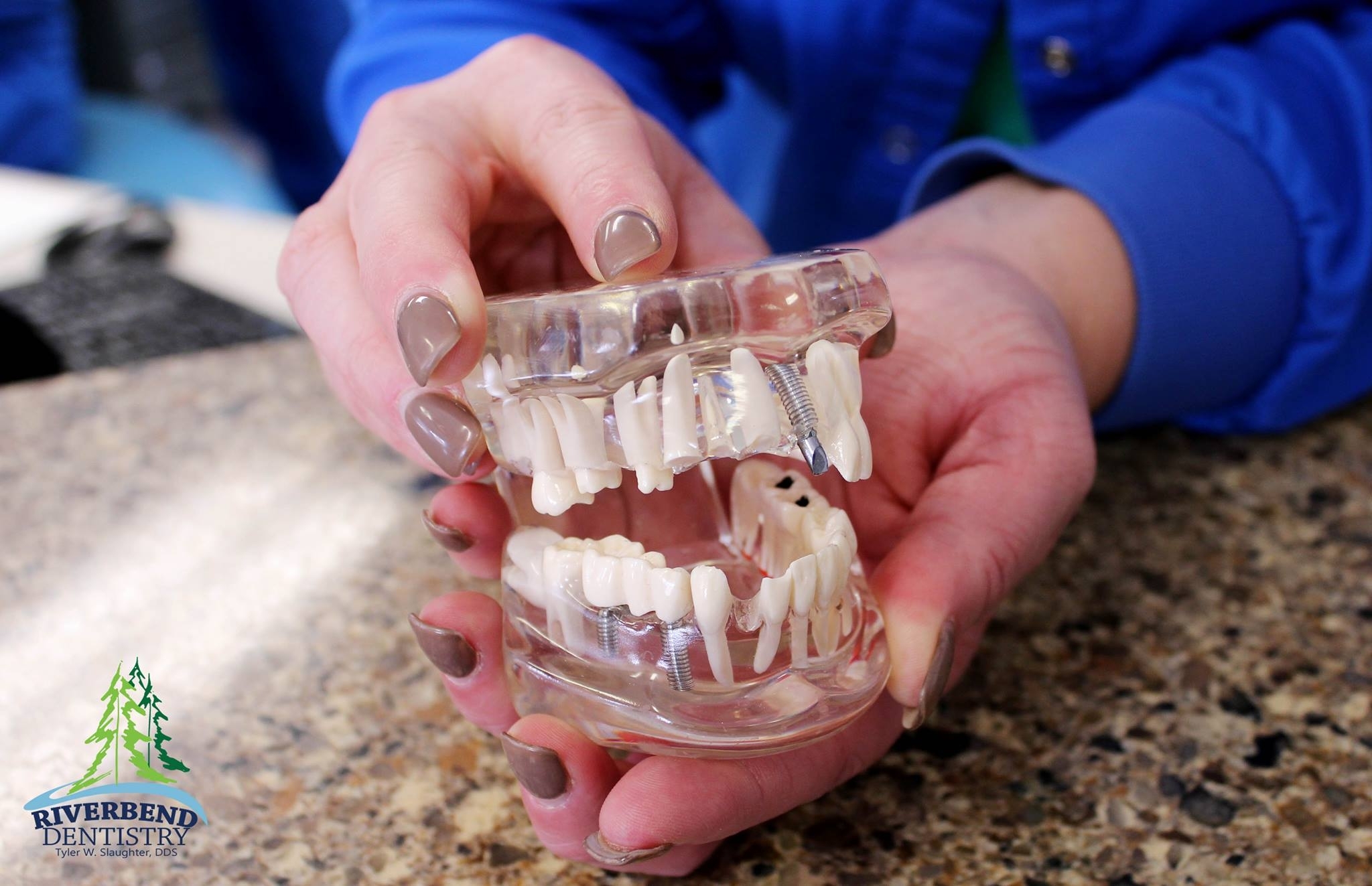Dental Implants, Crowns, Veneers