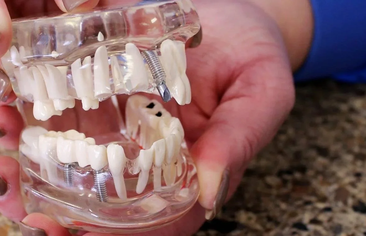 Dental Implants, Crowns, Veneers