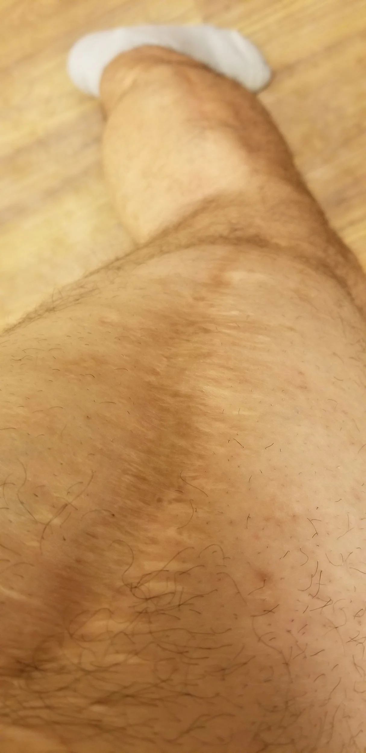EH-scar.jpg