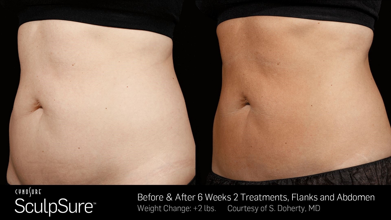 SculpSure-2.jpg