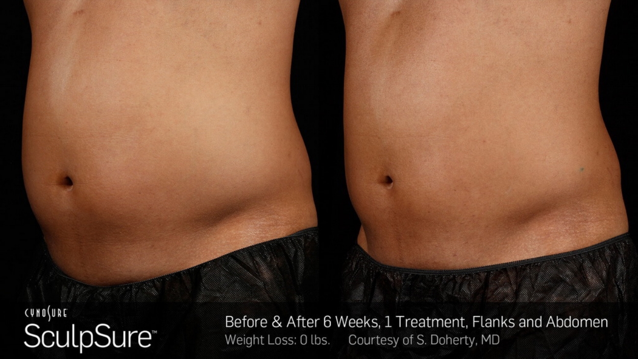 sculpsure-before-after.jpg