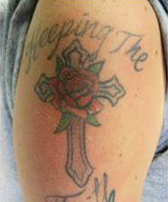 tattoo-removal-brisbane-10_1.jpg