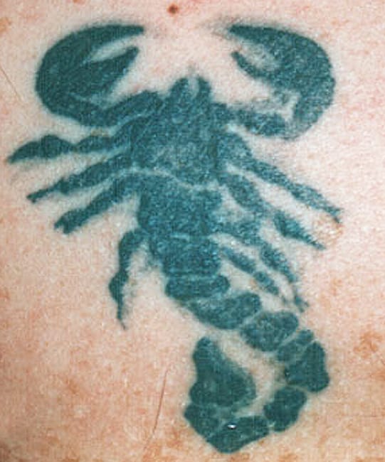 tattoo-removal-brisbane-7_1.jpg