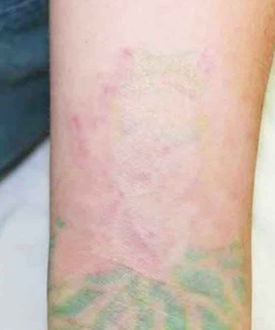 tattoo-removal-brisbane-9_2.jpg