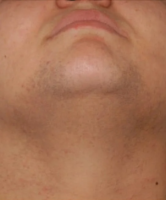 Super Laser Hair Removal Adells Chemist Clinic