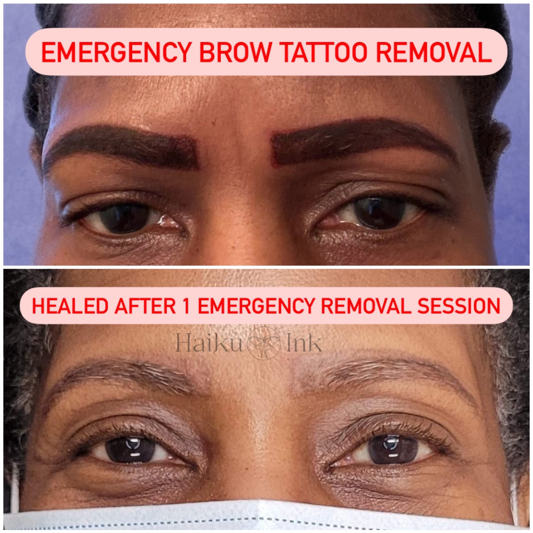 Emergency Microblading Ombre Eyebrow brow tattoo removal Columbia, MD Haiku Ink in Maryland