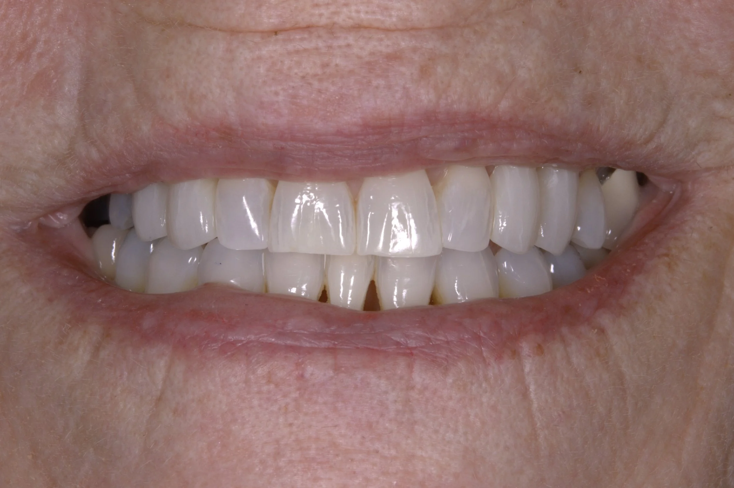 Frontal After Lip.jpg