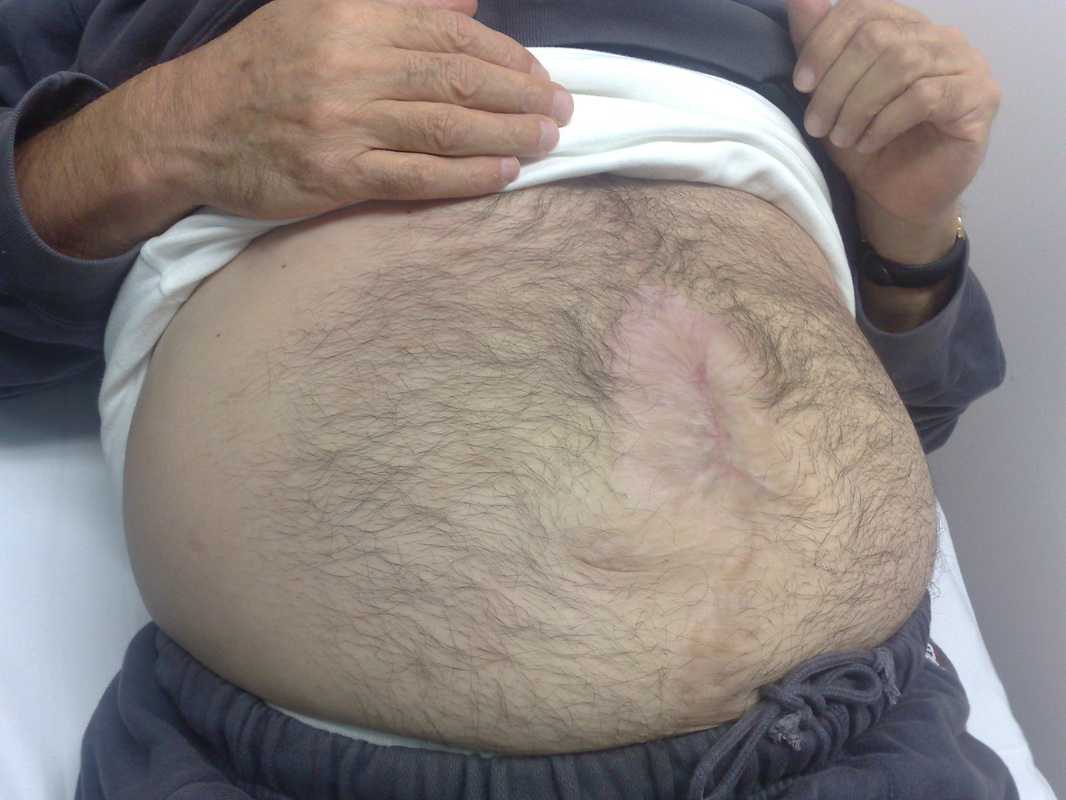 hernia4.jpg