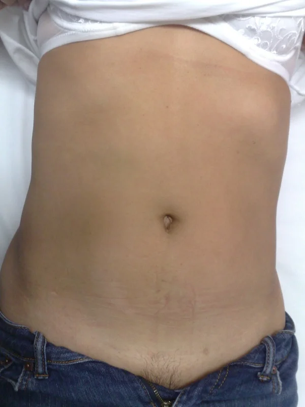 The patient in this underwent lower large bowel keyhole-surgery for resection of advanced colo-rectal cancer with liver and lung spreading. The patient is only 39 year old and, in spite of the advanced stage of the cancer and the poor prognosis, lived another six years following this surgery. The surgery was performed laparoscopically, removing the primary cancer completely, with lymph-node clearance and intra-corporeal anastomosis and no need of colostomy or ileostomy.