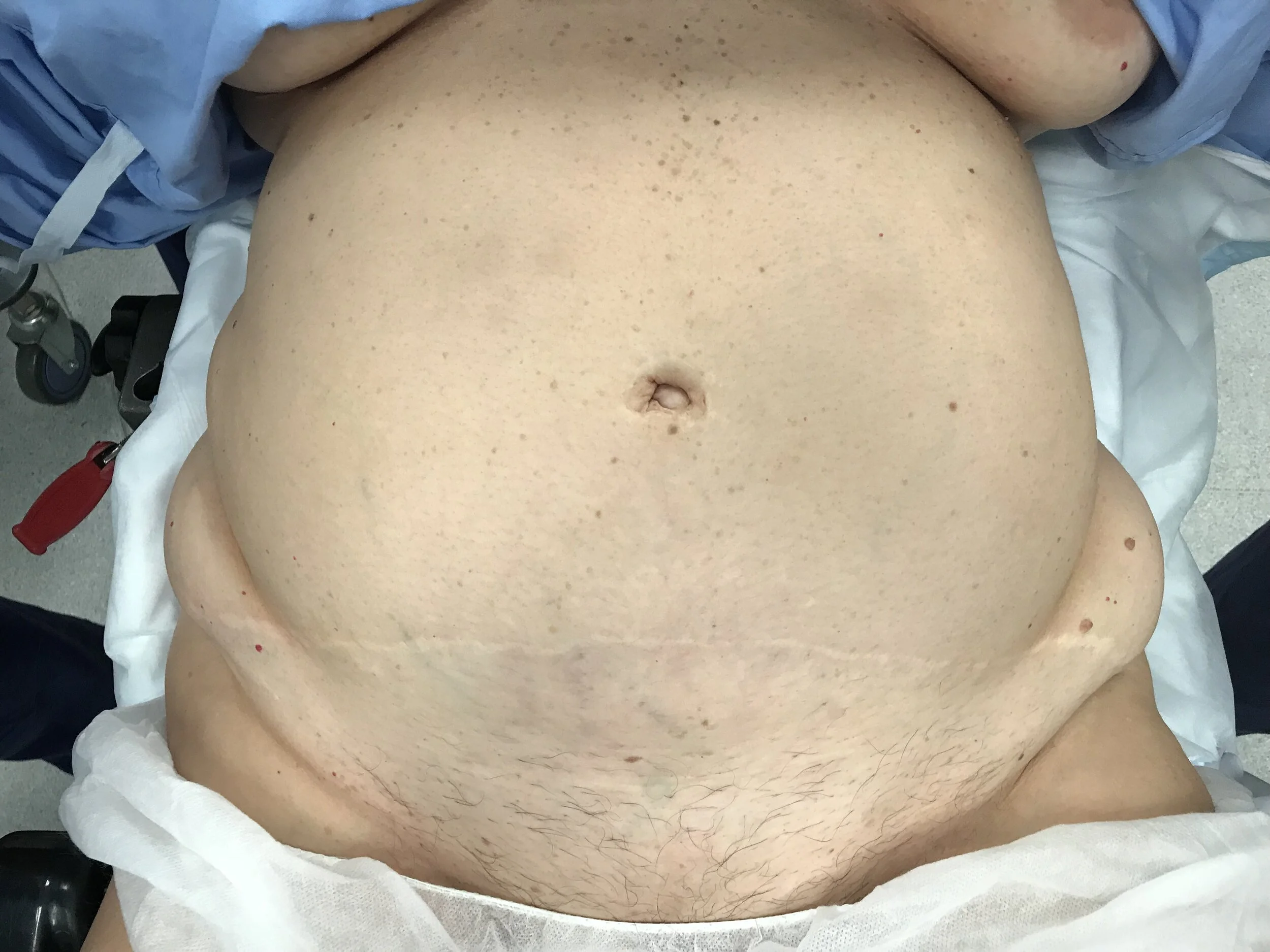 Here is an example of a good tummy-tuck