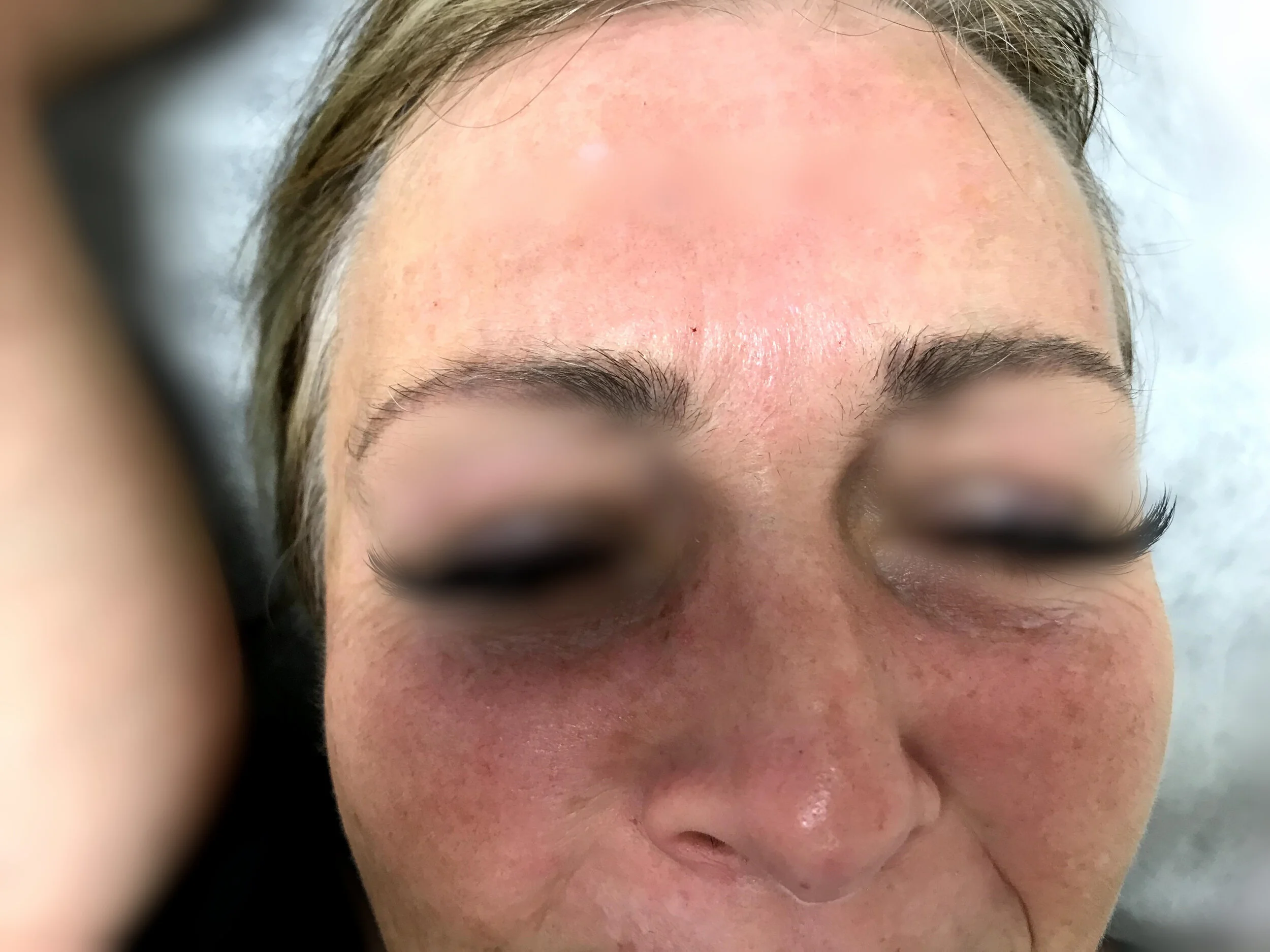 Forehead after.jpg
