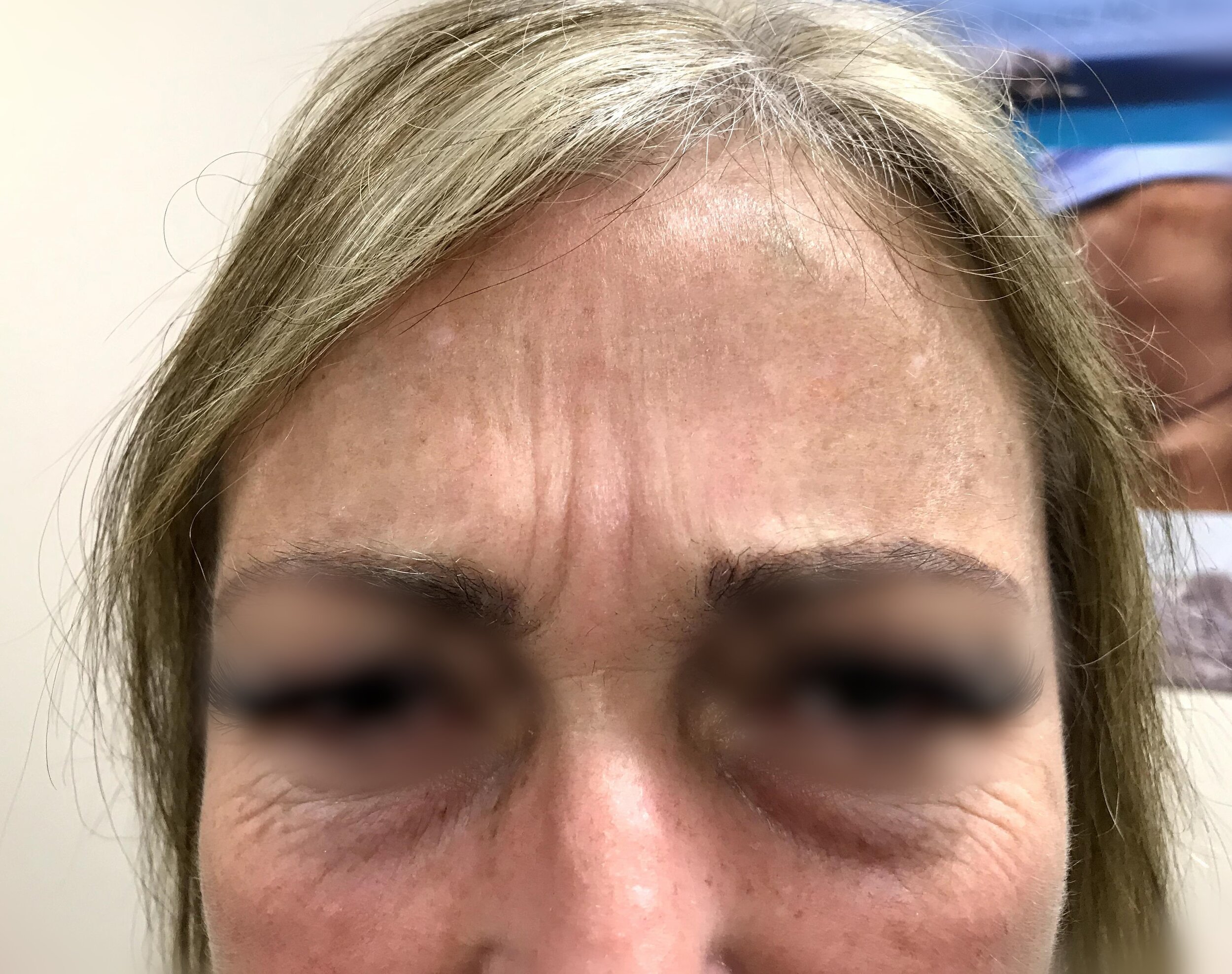 Forehead beforea.jpg
