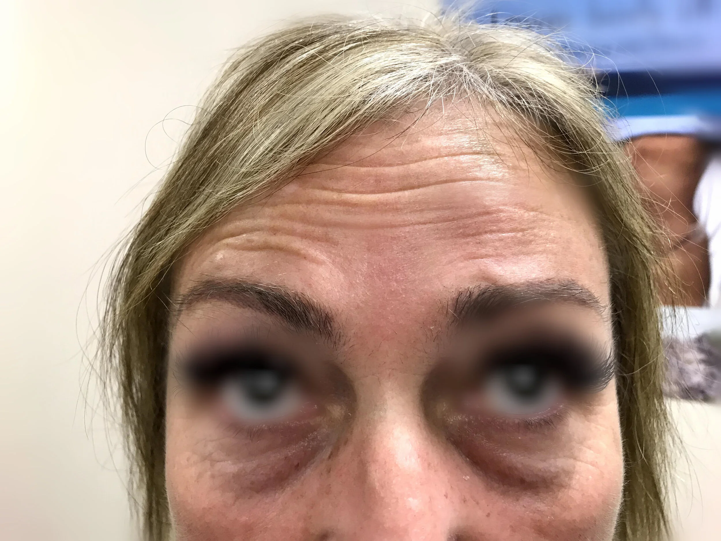 Forehead1 before.jpg