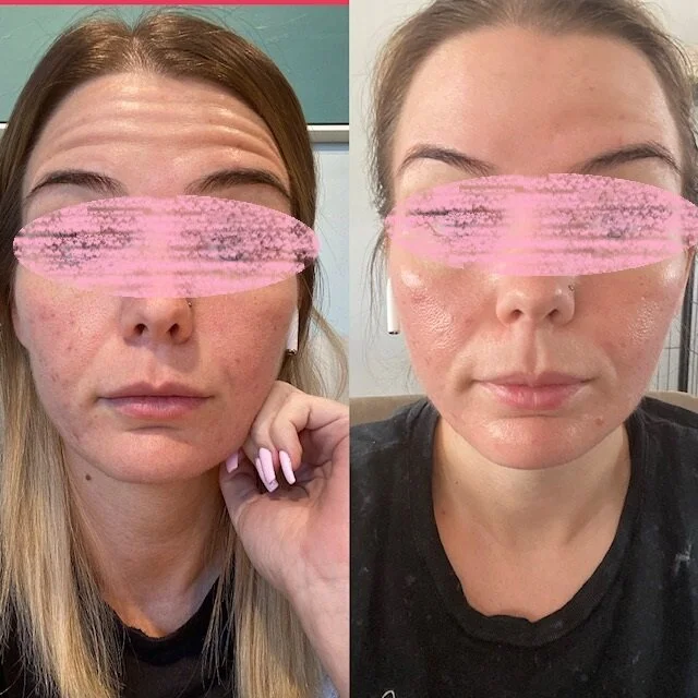 24 hours after Botox