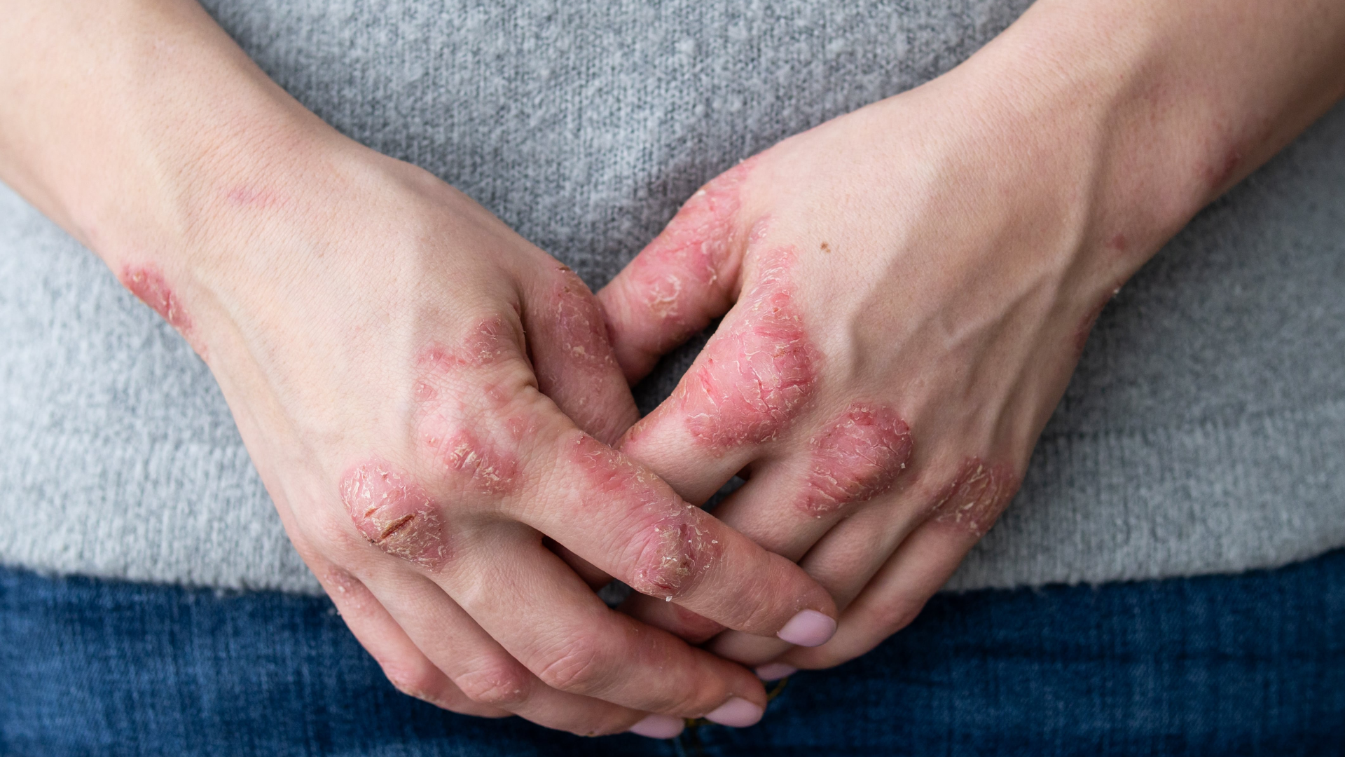 The-key-to-psoriasis-innovation-dispelling-the-jak_pharmaphorum.png