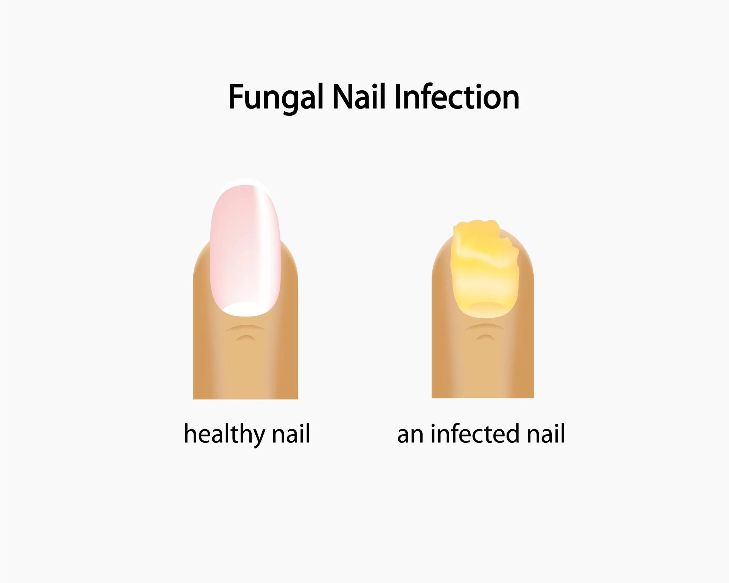 Treatment for Toenail Fungus, Ingrown Nail, Warts, Athlete's Foot