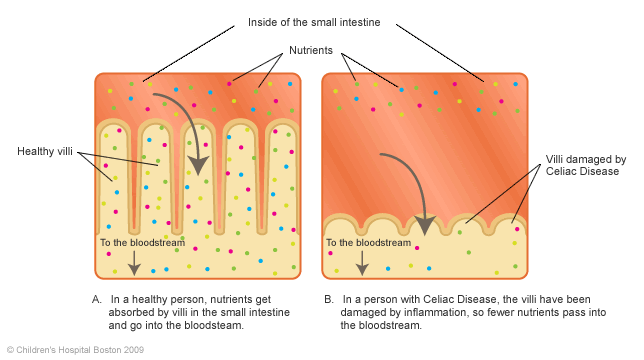 A diagram of what normal, healthy villi look like and function versus the villi of someone with Celiac ( Source )