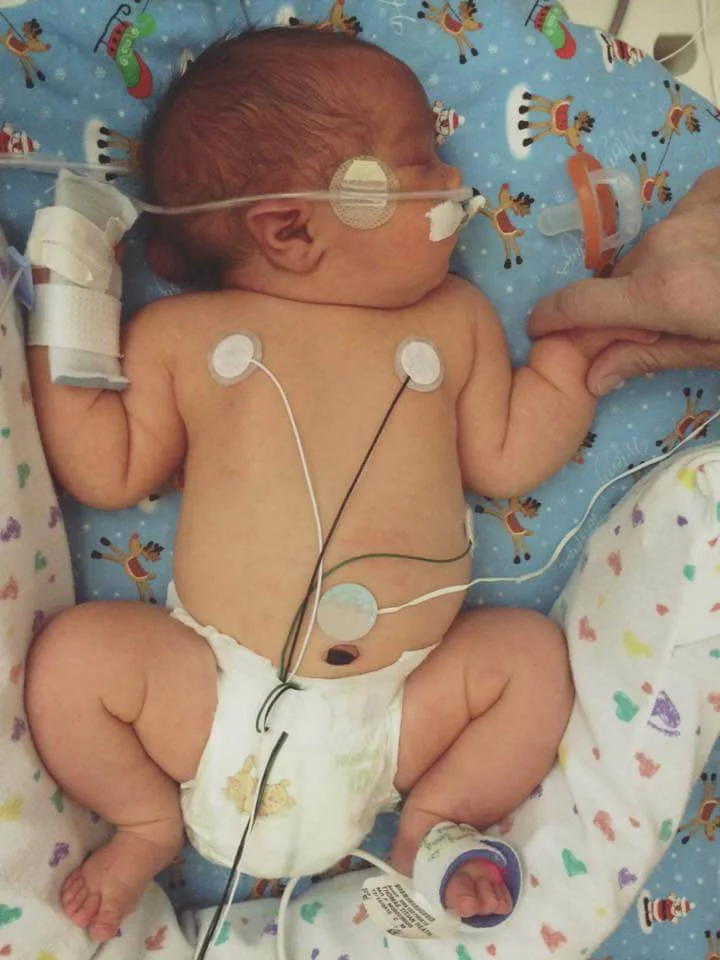 Titan spent two weeks at Arkansas Children’s after he was born. Looking closely, you can see the encephalocele pocket on the back of his head.