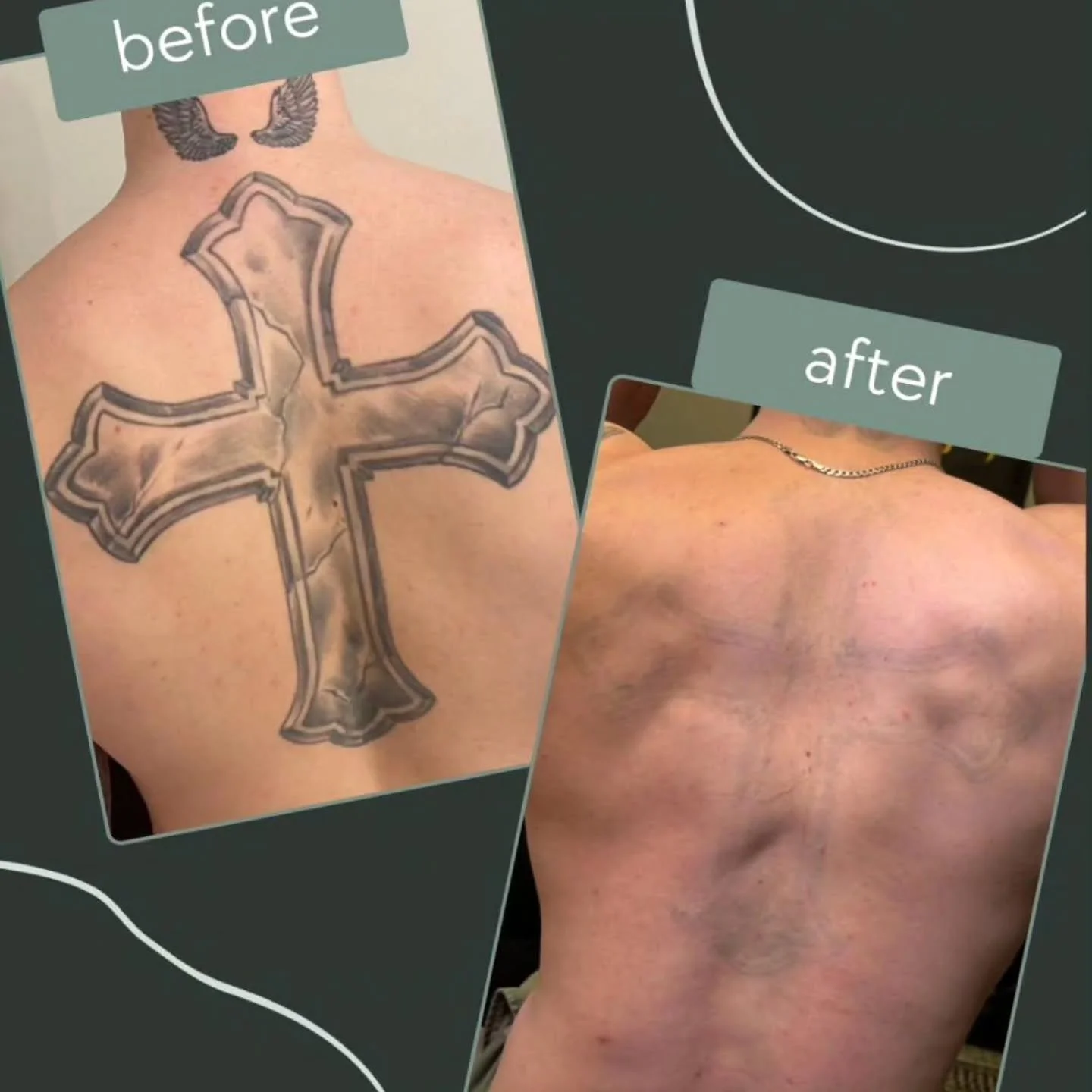 ⚡️ LASER REMOVAL ⚡️ 

Jesse has been working away on these two pieces and we're seeing some amazing progress. 👏 It's always encouraging to see these side by side photos. It's a bit of a journey to get there but always worth it.
This piece has maybe 